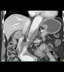 Vascular Right Adrenal Metastases - CTisus CT Scan