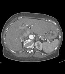 Vascular Right Adrenal Metastases - CTisus CT Scan