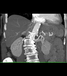 Vascular Right Adrenal Metastases - CTisus CT Scan