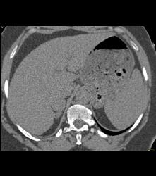 Incidental Subtle Pheochromocytoma - CTisus CT Scan