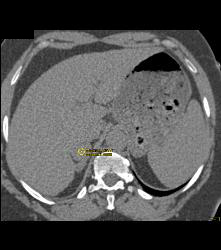 Incidental Subtle Pheochromocytoma - CTisus CT Scan