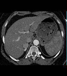 Incidental Subtle Pheochromocytoma - CTisus CT Scan