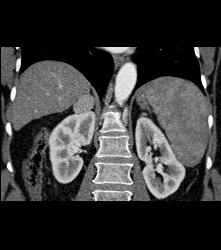 Incidental Subtle Pheochromocytoma - CTisus CT Scan