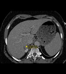 Incidental Subtle Pheochromocytoma - CTisus CT Scan