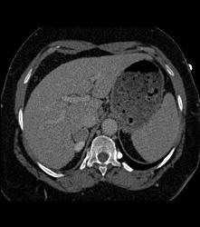 Incidental Subtle Pheochromocytoma - CTisus CT Scan