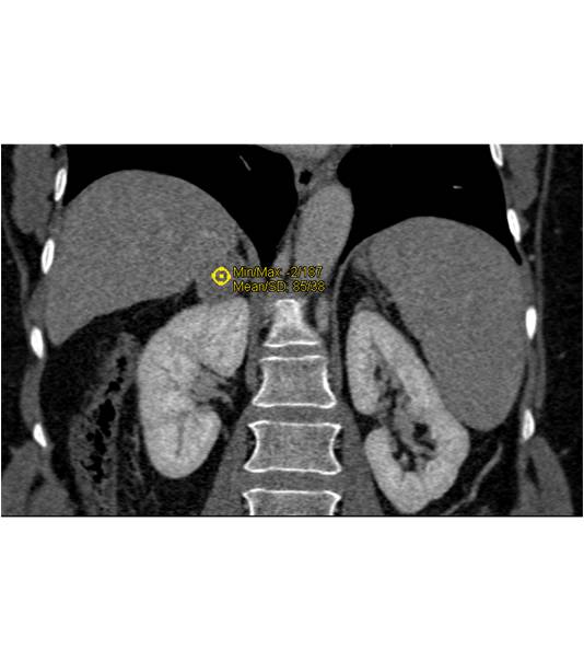 adrenal adenoma - CTisus CT Scan