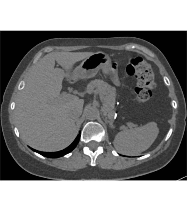 Metastatic renal cell carcinoma to the right adrenal gland - CTisus CT Scan