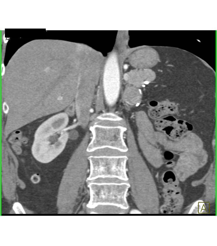 metastases to the right adrenal gland from renal cell carcinoma - CTisus CT Scan