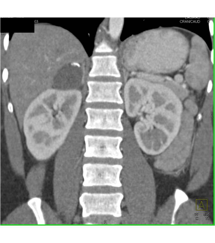 old hematoma of right adrenal gland - CTisus CT Scan