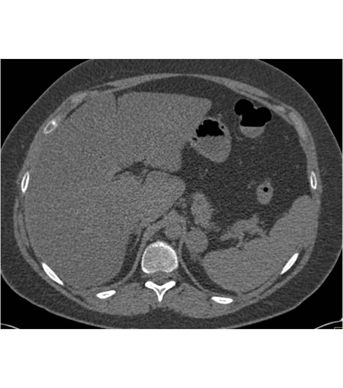 incidental left adrenal adenoma - CTisus CT Scan