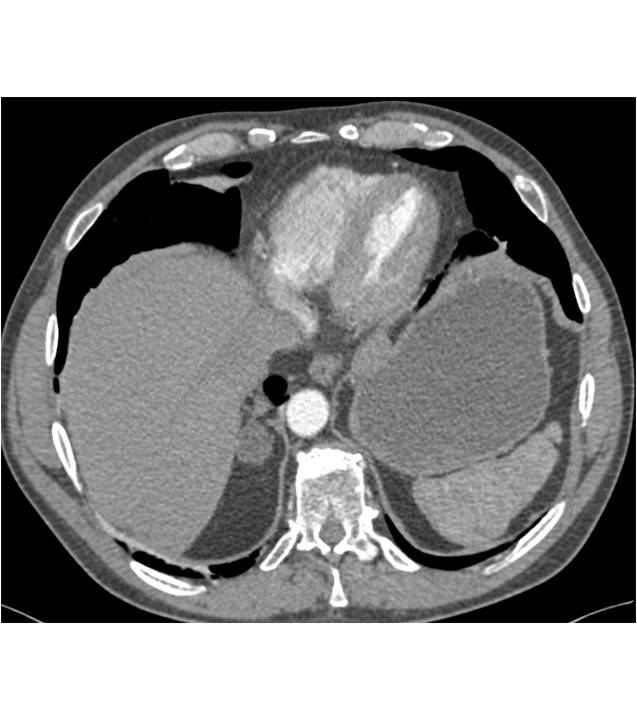 metastatic melanoma to the right adrenal gland - CTisus CT Scan