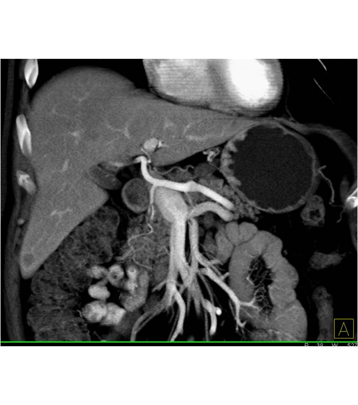 melanoma metastatic to the adrenal and the liver - CTisus CT Scan