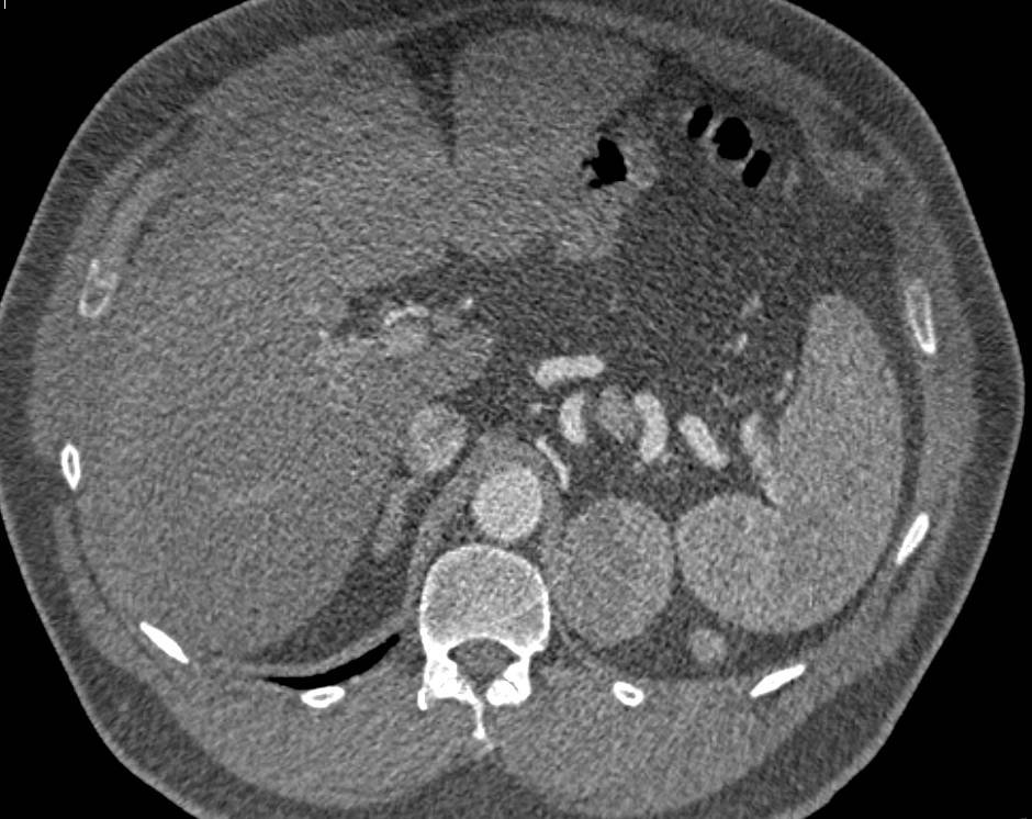 Pheochromocytoma Incidentally Detected on an Aortic Root Evaluation Study - CTisus CT Scan