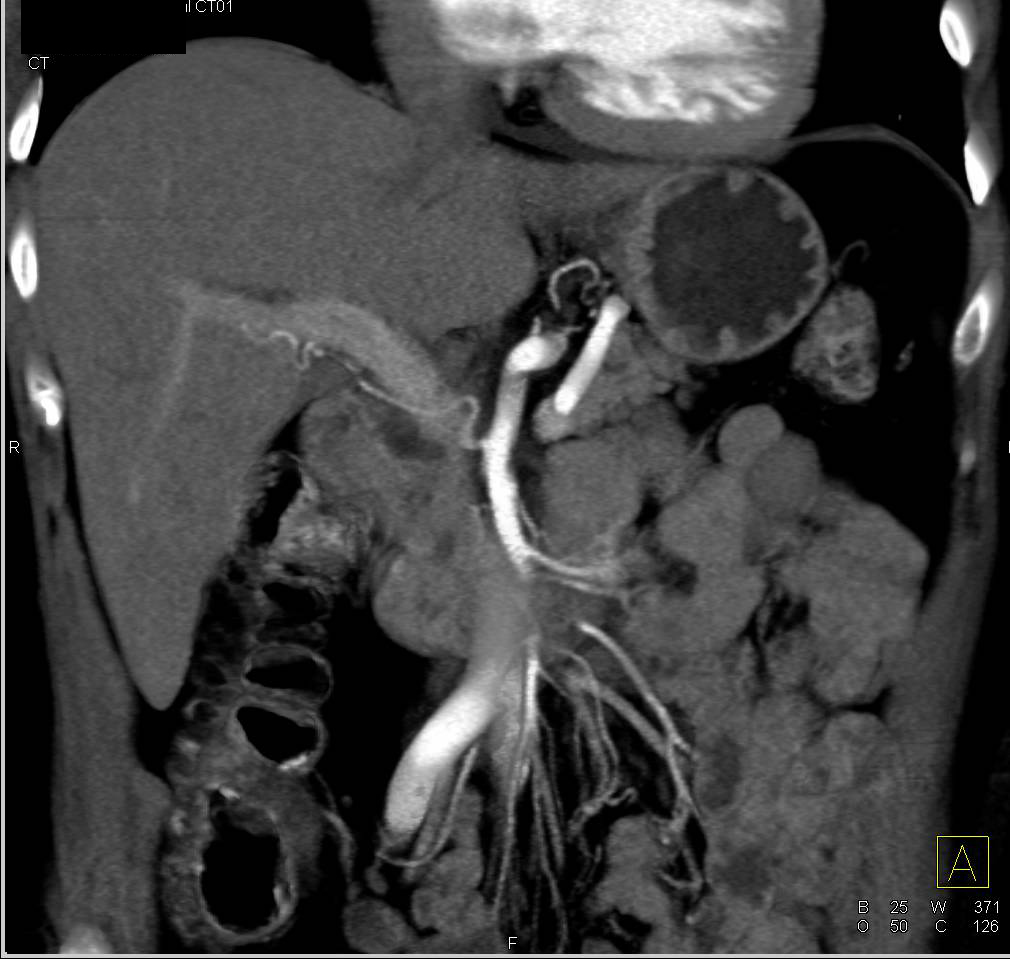 Nodal Mass Anterior to Left Renal Artery and Vein - CTisus CT Scan