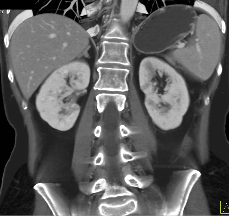 Normal Venous Phase Imaging of the Kidnsys and Adrenals - CTisus CT Scan