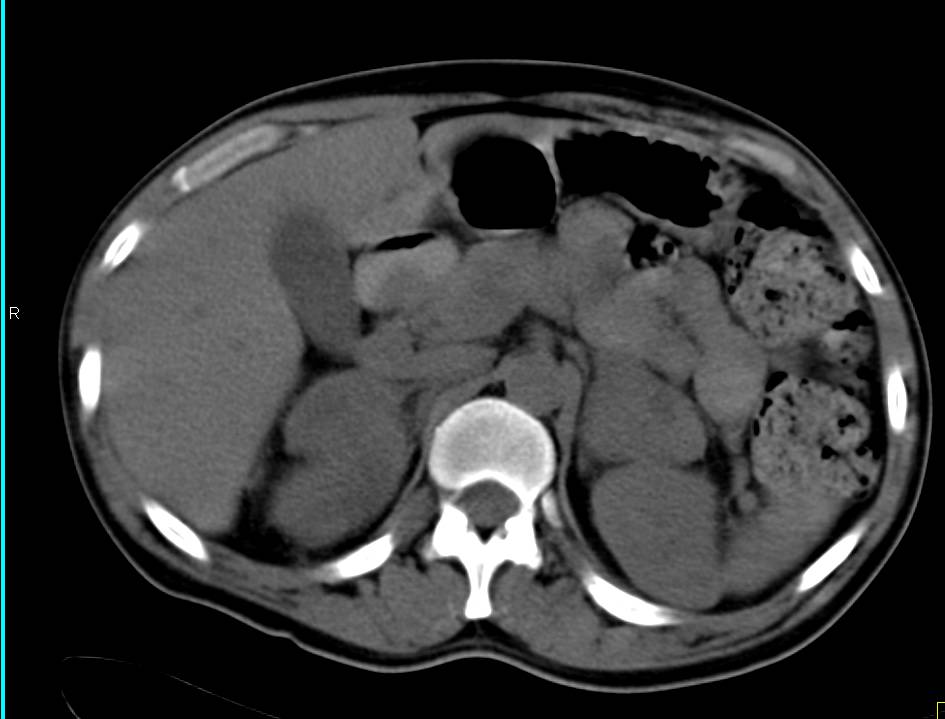 Metastatic Melanoma to the Adrenal Glands - CTisus CT Scan