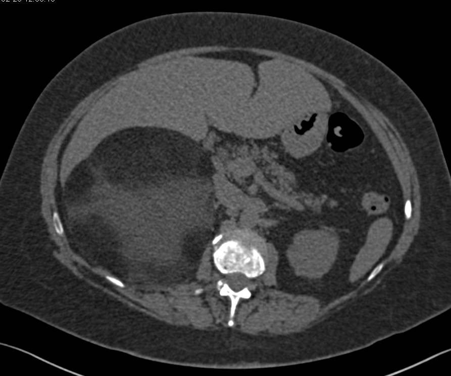 Giant Adrenal Myelolipoma - CTisus CT Scan