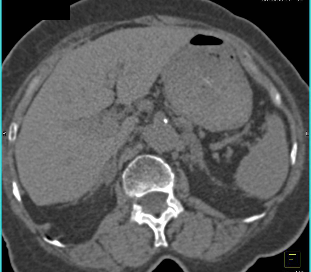 Adrenal Adenoma - CTisus CT Scan