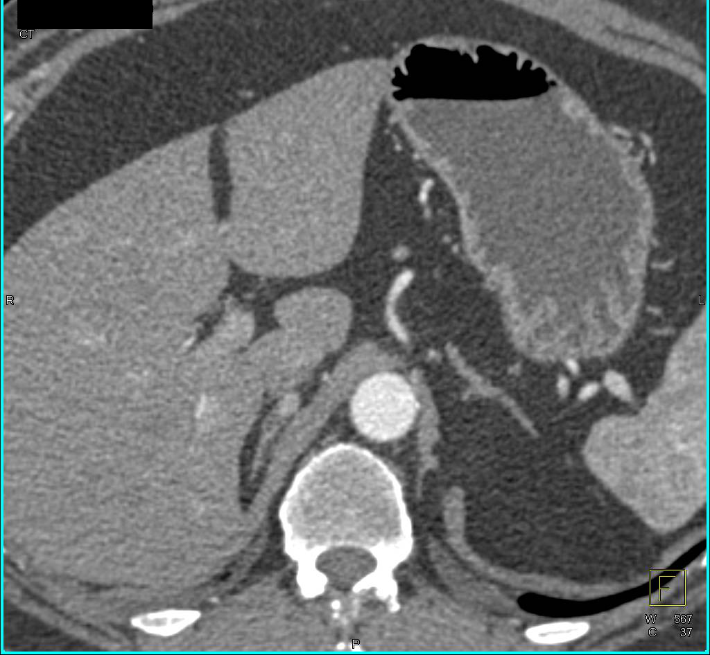 1 cm Metastases to the Right Adrenal Gland from Renal Cell Carcinoma - CTisus CT Scan