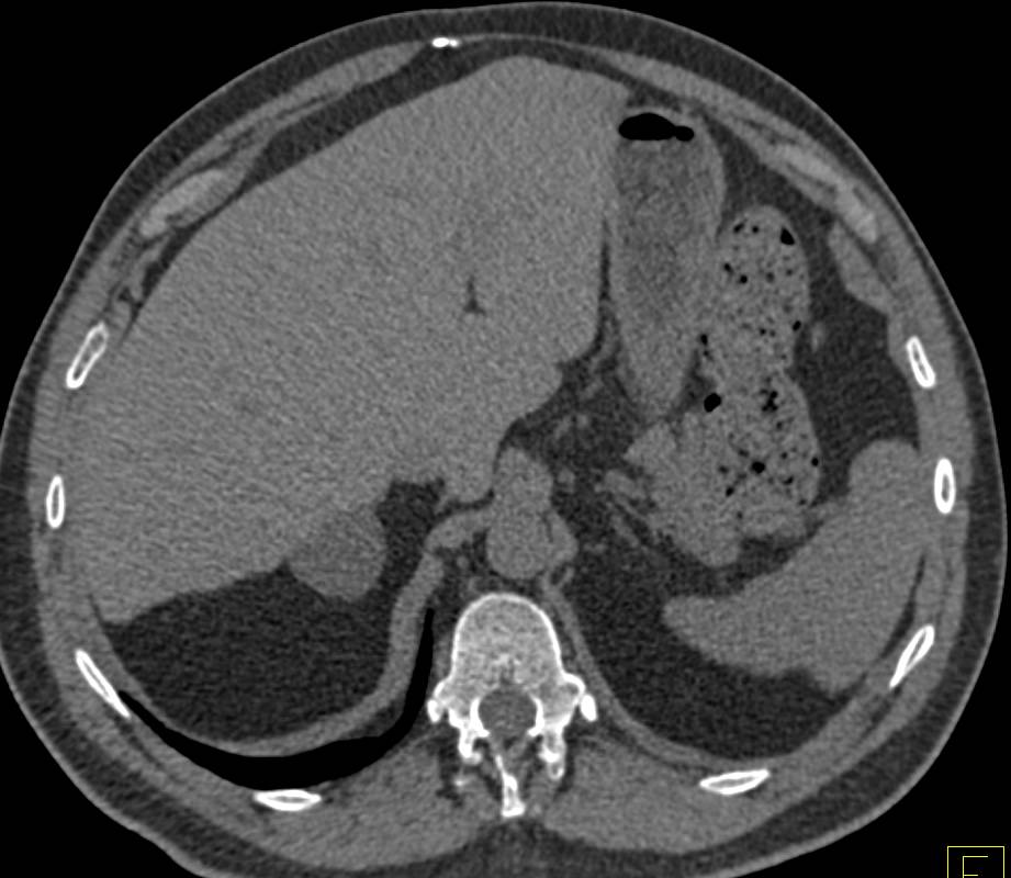 Classic Adrenal Adenoma on Non-contrast CT with attenuation value of 5HU - CTisus CT Scan