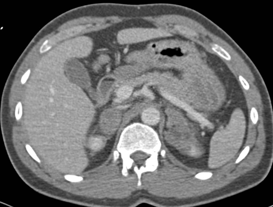 Bilateral Adrenal Hemorrhage - CTisus CT Scan