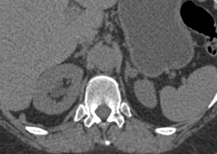 Left Adrenal Adenoma - CTisus CT Scan