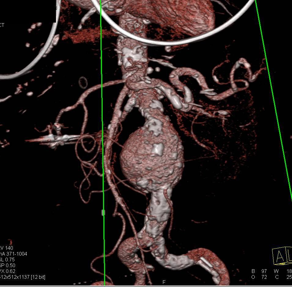 Abdominal Aortic Aneurysm with Vascular Mapping Shows Extensive Calcified Plaque - CTisus CT Scan