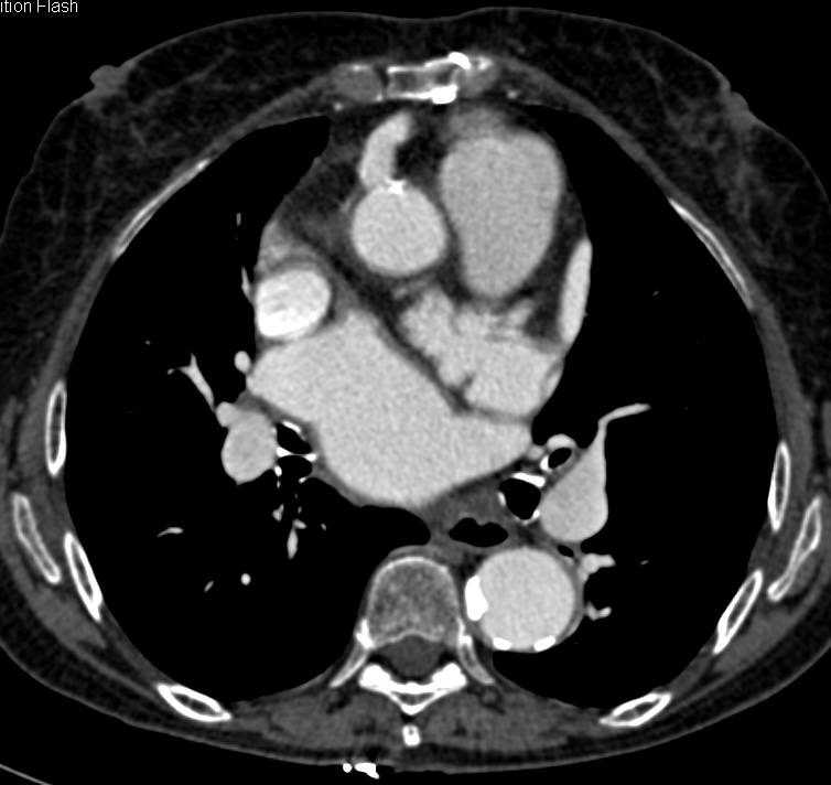 Right Adrenal Hematoma in a Patient Following Cardiac Surgery on Coumadin - CTisus CT Scan