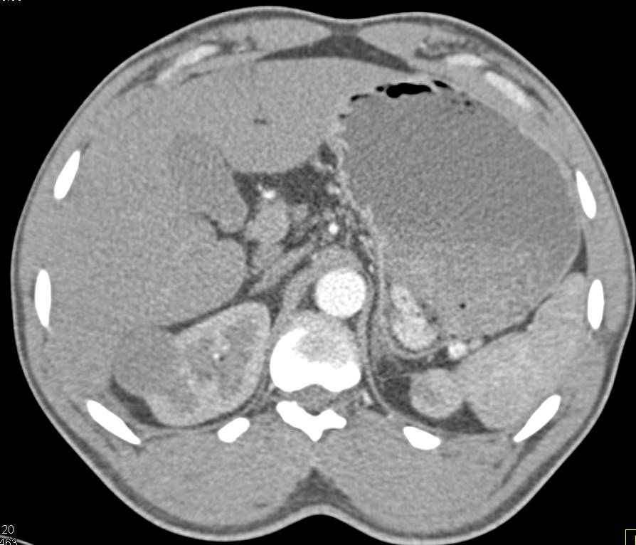 Low Grade Renal Cell Carcinoma with Enhancement of Around 20 HU Over the Scan Sequence - CTisus CT Scan