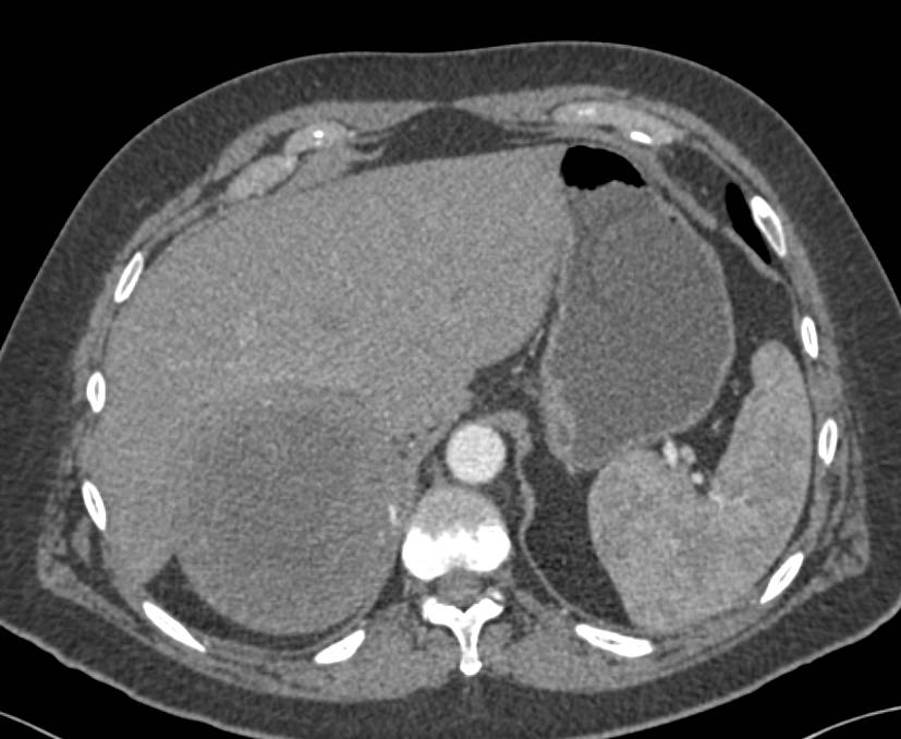 Chronic Adrenal Hematoma (simulates a tumor) - CTisus CT Scan