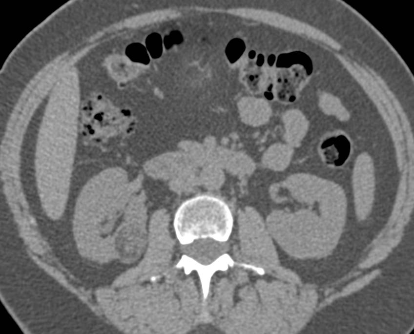 2cm Right  Renal Myelolipoma - CTisus CT Scan