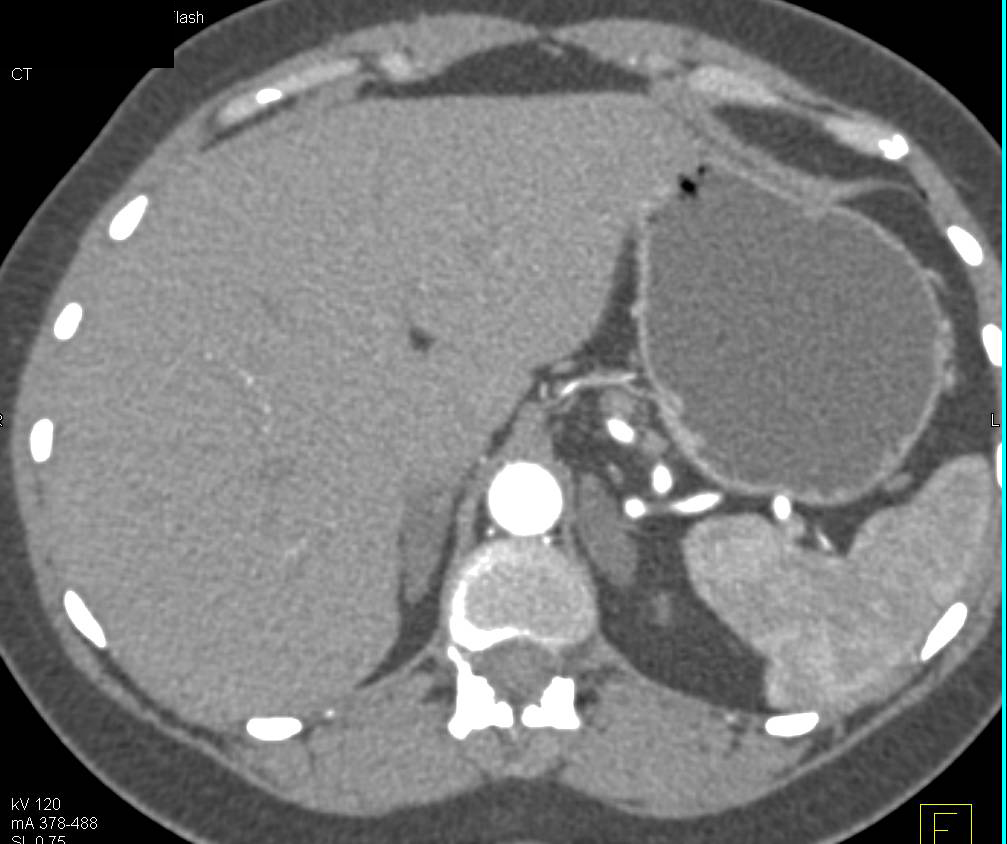 Adrenal Hyperplasia - CTisus CT Scan