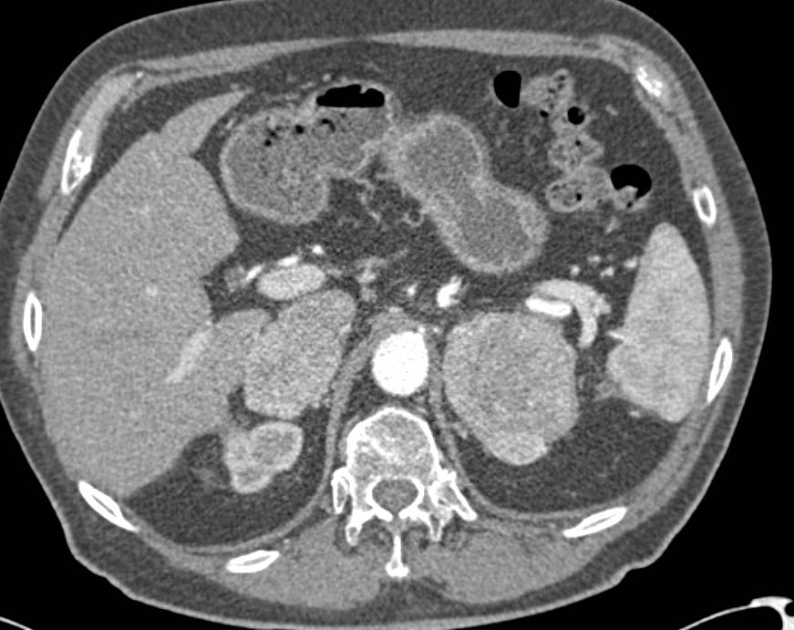 Bilateral Adrenal Metastases due to Renal Cell Carcinoma - CTisus CT Scan