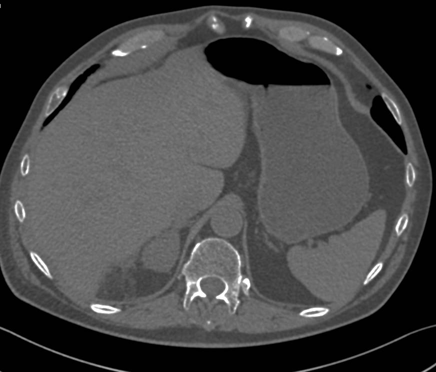 Adrenal Hemorrhage - CTisus CT Scan