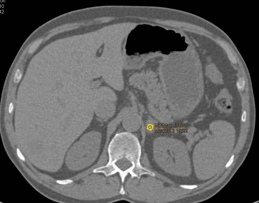 Adrenal Metastases with Washout Study - CTisus CT Scan