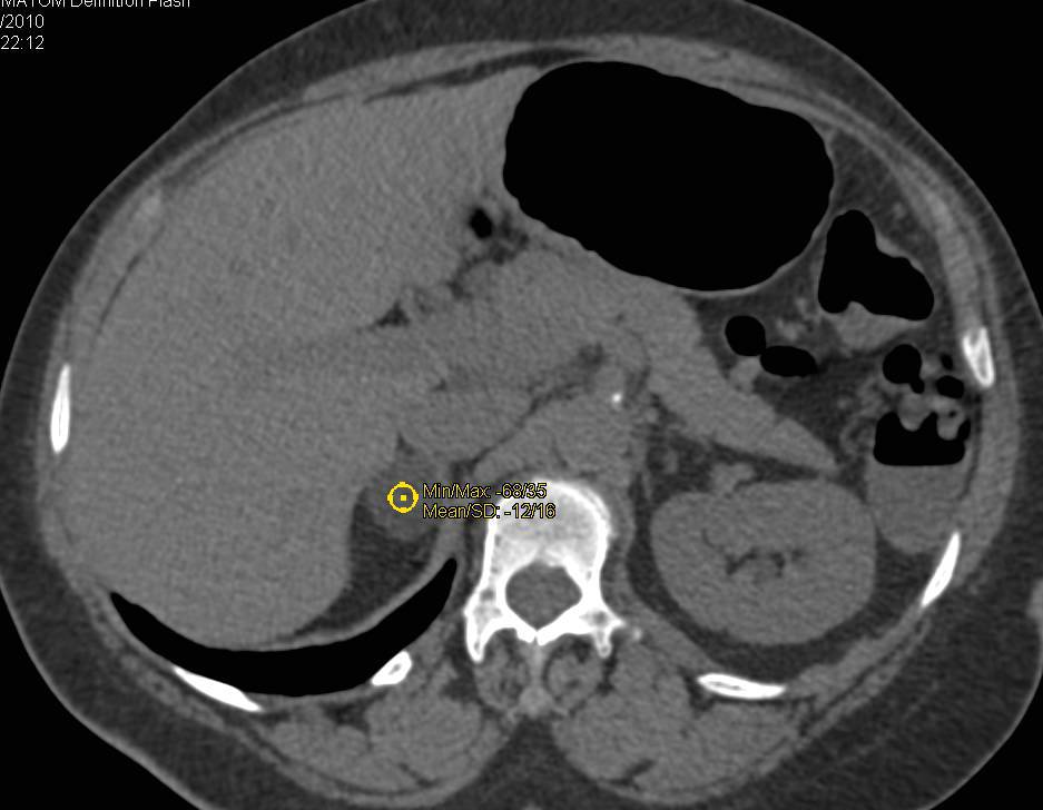 Adrenal Adenoma - CTisus CT Scan