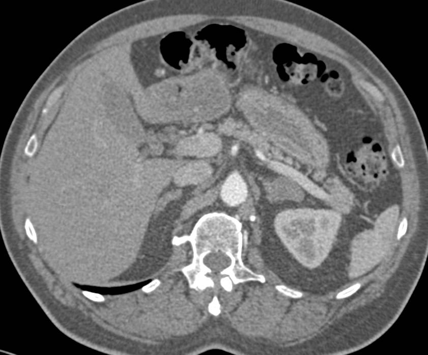 Adrenal Adenoma and Vascular Liver Metastases - CTisus CT Scan