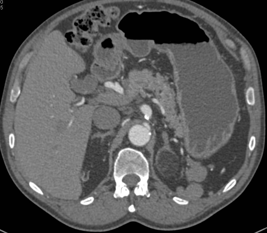 Myelolipoma of the Left Adrenal Gland - CTisus CT Scan