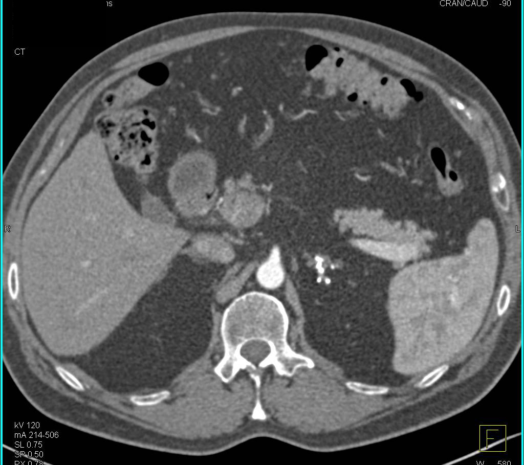 Myelolipoma of the Left Adrenal Gland - CTisus CT Scan