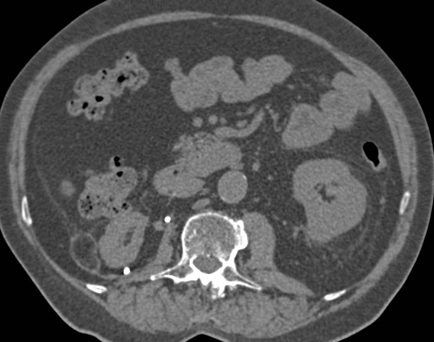 Recurrent Renal Cell Carcinoma Metastatic to the Adrenal Gland - CTisus CT Scan