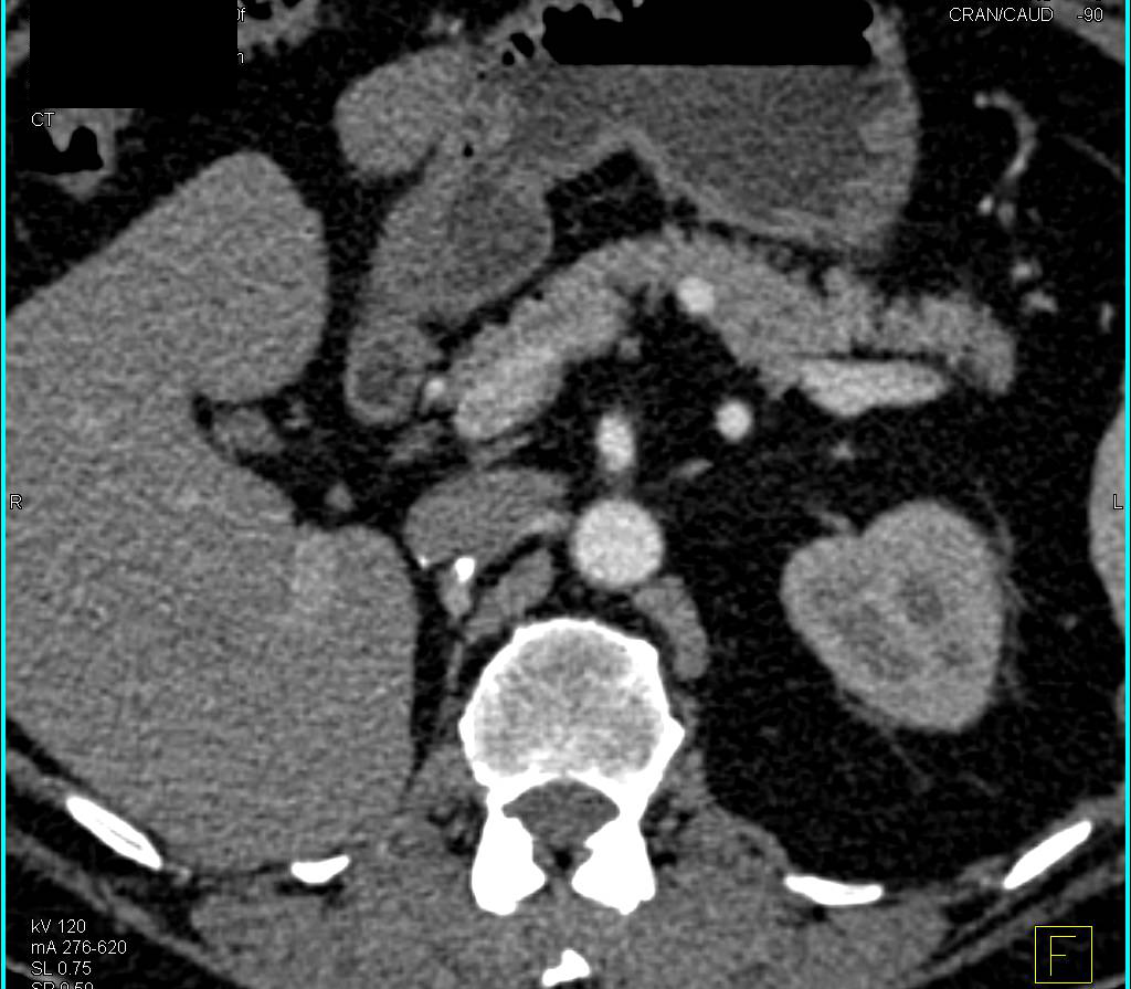 5 mm Metastases to Right Adrenal Gland from Renal Cell Carcinoma - CTisus CT Scan