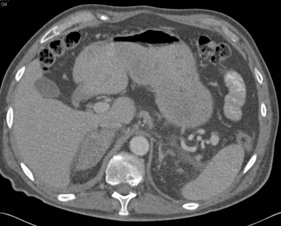 Right Adrenal Hemorrhage - Adrenal Case Studies - CTisus CT Scanning