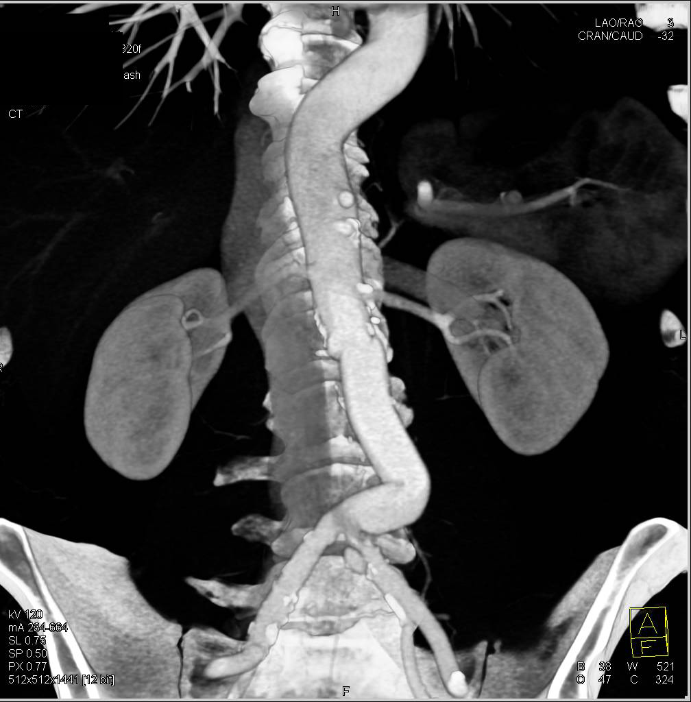 Aortic Aneurysm s/p Repair with 3D map - CTisus CT Scan