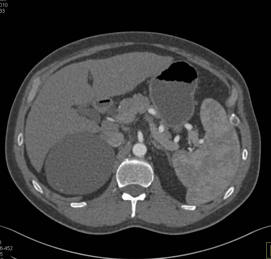 Adrenal Cyst - CTisus CT Scan