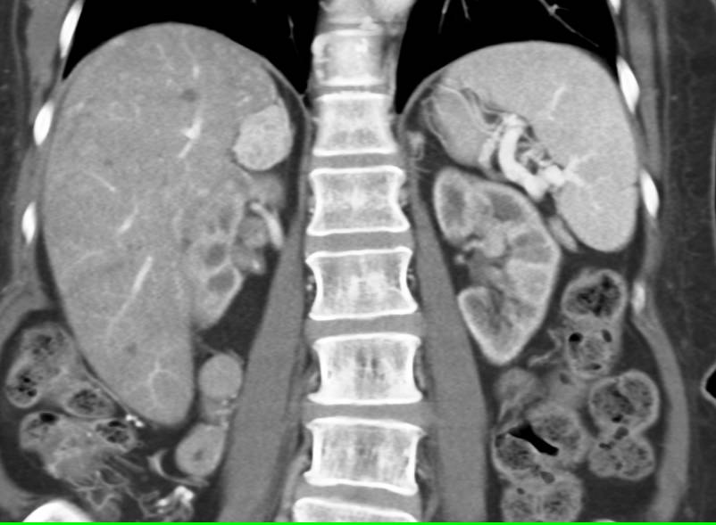 Pheochromocytoma of the Right Adrenal Gland - CTisus CT Scan