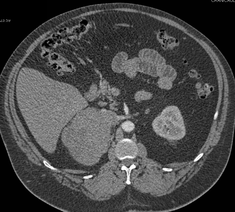 Primary Leiomyosarcoma of the Right Adrenal Gland (rare) - CTisus CT Scan