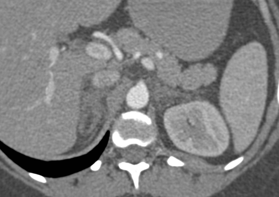 Adrenal Hyperplasia - CTisus CT Scan