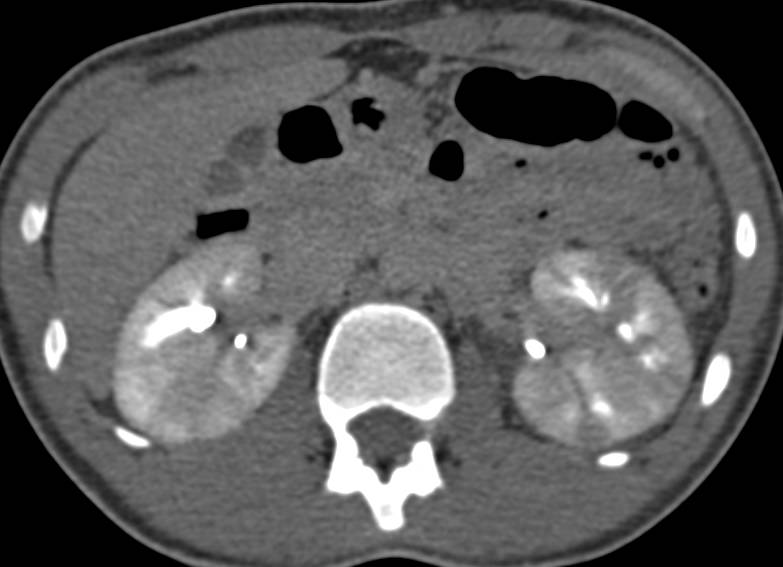 Acute Pyelonephritis with Patchy Nephrogram Best Seen on Late Phase Imaging as Well as Arterial Phase Imaging. Striated Nephrogram seen. - CTisus CT Scan