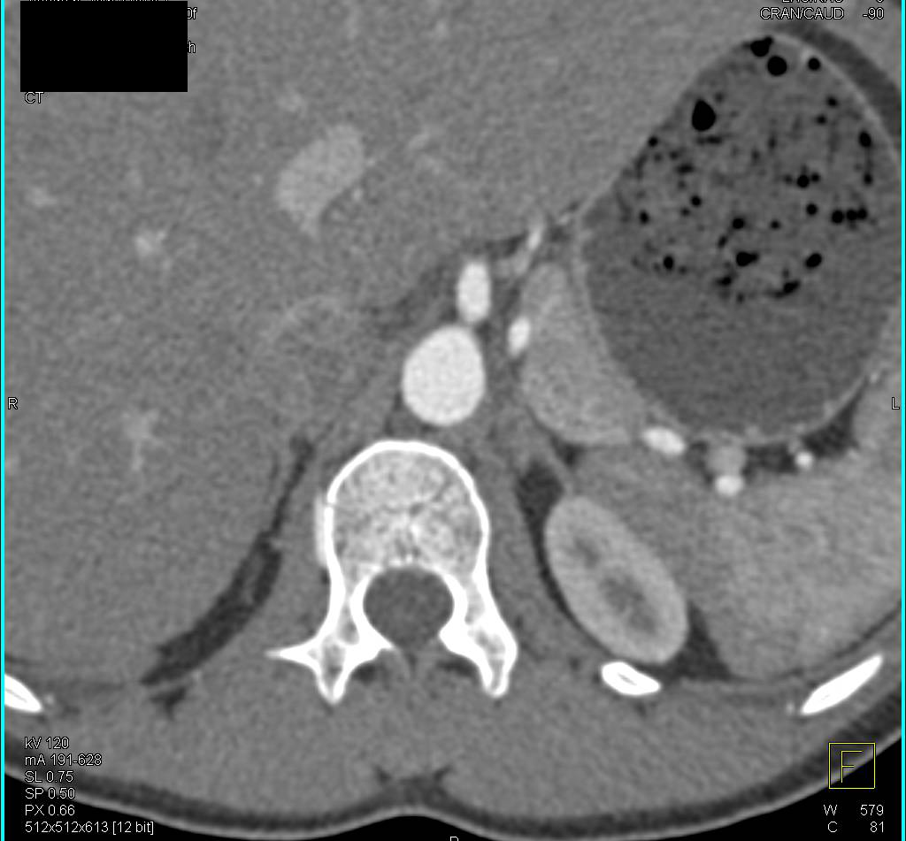 1cm Aldosteronoma Left Adrenal Gland - CTisus CT Scan