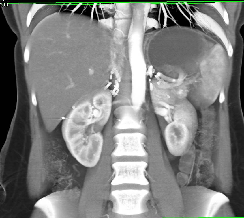 3D CT of Bilateral Adrenalectomies - CTisus CT Scan